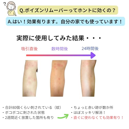 NEW エクストラクター ポイズンリムーバー 強力型 ハチ ブヨ トコジラミ ヤマビル などの虫刺され 毒吸引に (通常版, 1, セット) 中間 画像